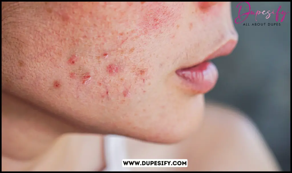 Blackheads